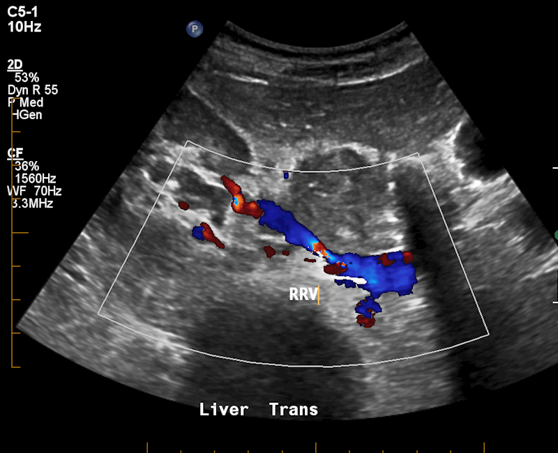 A Rare Case of Postpartum Ovarian Vein Thrombosis